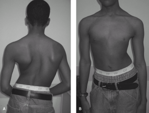 Untreated Scoliosis. It only gets worse as you age. 