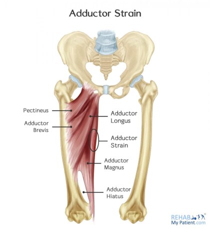 Adductor_Strain