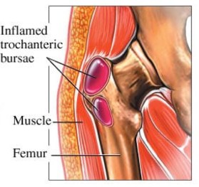 Hip Bursitis