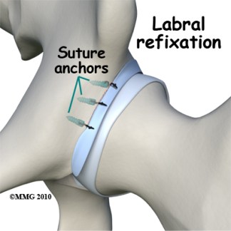 hip_labral_tear_refixation