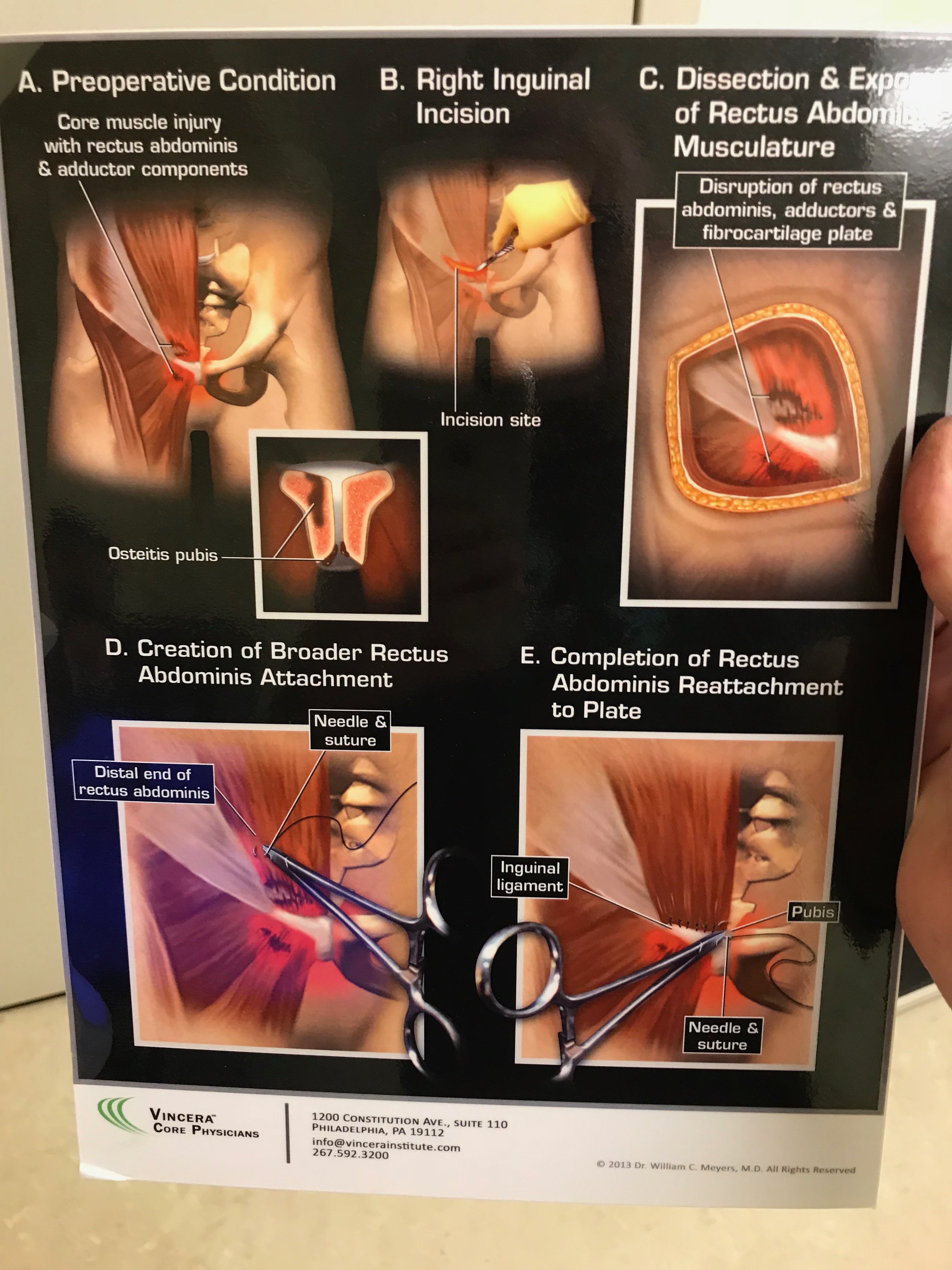 Muscle Operation Ahead of Schedule – Bring it On