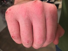 dry-cracked-hands